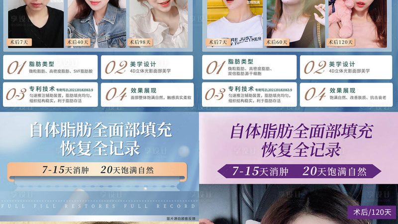 鼻子修复手术通常分为以下几个步骤：