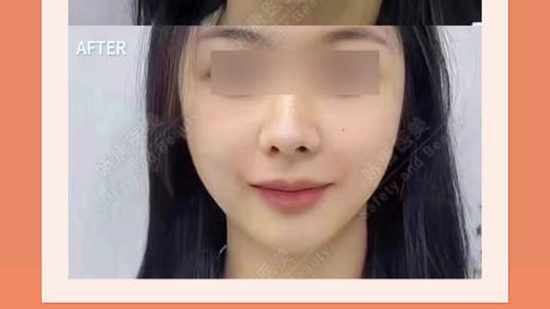 激光美容仪器，正确使用之道