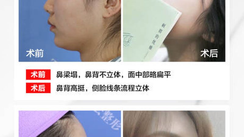 广州注射美容材料批发市场：揭秘高品质美容材料的选购之道**