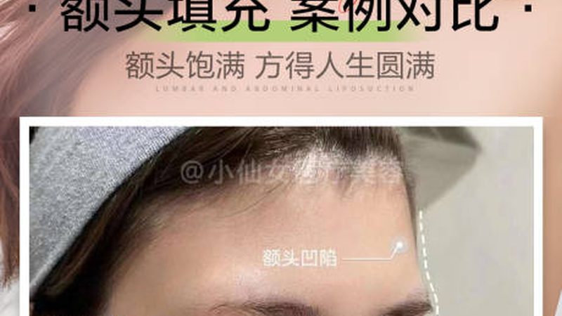西安磨骨手术恢复期：揭秘术后恢复全流程